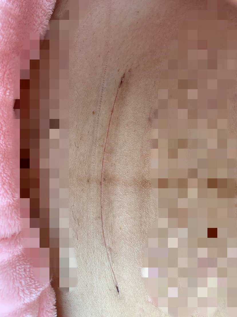 这是剖腹产20天的图片
