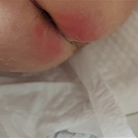 有用过熬的香油，给娃涂抹红屁屁的吗？效果怎么？