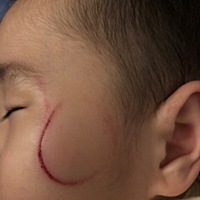 孩子摔倒脸碰到了水壶口上 不知道以后会不会留疤呀？现在酒精消毒 等结痂后去医院开点祛疤药 也不知道有...