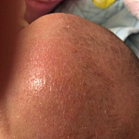 求助宝妈，七个月的宝宝头上有湿疹涂什么比较好？有的药膏怕有激素，不敢给她涂