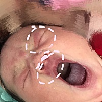 到现在十几天了还是红 哭或者使劲的时候也红 有知道这是什么的吗？