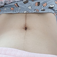 有没有宝妈知道中间这条黑线怎样淡化啊？  颜色太深了。后两个月才变黑的。现在生了二十多天了，一点都...