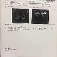 我多囊卵巢综合症（经常两三个月不来）11月促排卵，11月21日人工受精，12月1日排卵纸测出怀孕，hcg翻倍...