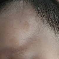 宝宝涂抹药膏留下的色素沉淀怎么办