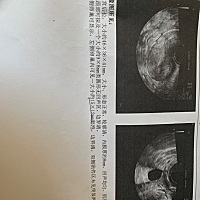 图1是7号做的监测，只有一个卵泡，图2是今天去监测的，发现之前的卵泡没有了，反而还看到了两个比较小的...