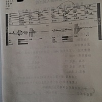 宝宝出生第二天做的新生儿听力筛查，左耳未通过，医生让42天后复查，请问有宝妈遇到过这样情况吗？