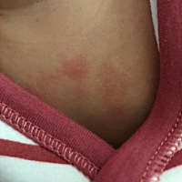 这是湿疹吗