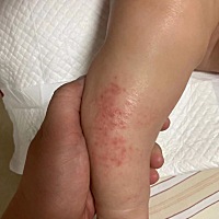 这两天宝宝腿上起湿疹，今天擦了擦有点破皮出水，各位宝妈知道啥药好用吗？