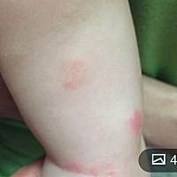 宝妈们，有没有宝宝身上长了许多类似这种粗燥红红的，擦了好多药都不见好。有宝妈知道这种是什么的吗，...