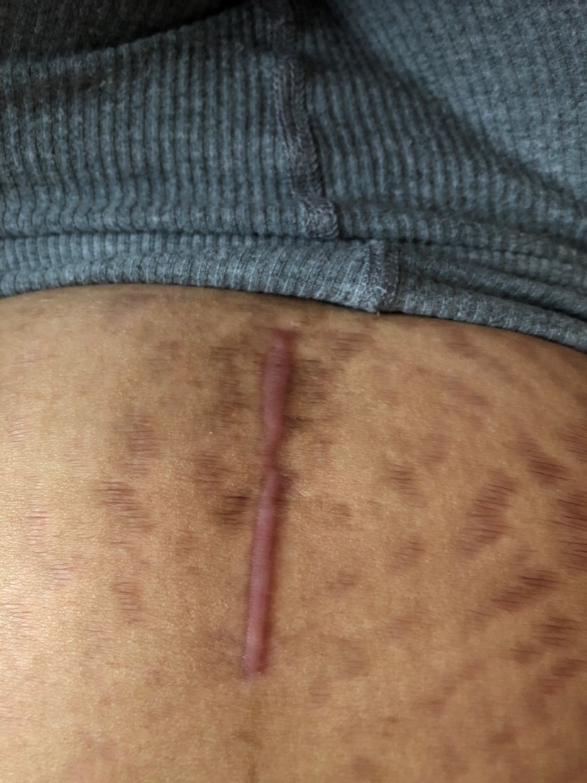 剖腹产疤痕