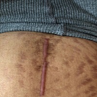 剖腹产刀疤好恐怖啊，这疤成这样了，以后就这样了吗 剖腹产疤痕