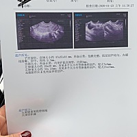 1月6号来月经的～ 一直试纸测排卵 今天两杠了，做了b超  医生说卵泡过大 需要打促排？ 有没有一样的？你...
