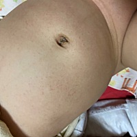 哪位宝妈知道这是咋回事呢 上午还是一点点现在晚上就多了 这是湿疹还是痱子呢