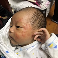 孩子脸上长疙瘩