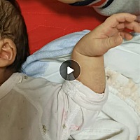 这是什么原因呢？右手看起来很有力握拳动来动去，左手手腕下垂，手臂动一下又掉下去。希望帮忙回答一下呢