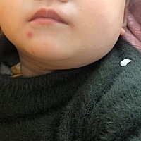 宝宝十一个多月，左下巴长了一疙瘩是怎么回事，之前是大小脸，没有这么明显，昨天才发现有疙瘩，而且有...