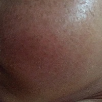 婴儿湿疹擦了药膏后就成这样，是怎么回事？过后会走的吗？