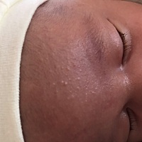 宝宝马上两个月了   从月子里脸上就有湿疹  现在还没消下去  也没涂什么药膏   现在看着太难受了  有没...