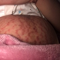 有没有宝妈有方法治疗的 生完之后开始痒 太难受了 用了炉甘石涂抹 还是痒 没什么用啊  一热就开始痒 又...
