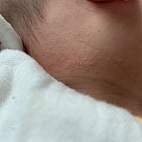 宝宝脖子这个是湿疹吗，身上也有，