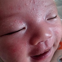 宝宝今天19天了，前两天开始长了小痘痘，还有小白头的那种，先是眼周，然后额头，今天一看越来越多了。...