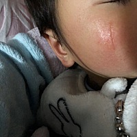 各位宝妈帮我看看我崽脸上的凹痕印还能不能长平？2个多月了还没好，急！
