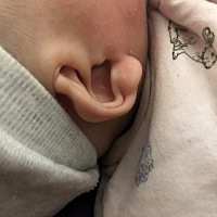 宝妈们 小孩耳朵缩进去要不要做调整呀？自己会不会长出来？
