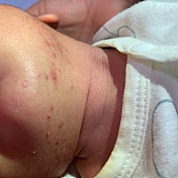 孩子下巴这几天长的红色疙瘩。不知道是什么，摸得婴宝不见好反而越来越多。家里23度就穿一件衣服不出汗...