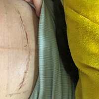 13天的肚子、已经不疼了