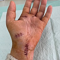 真倒霉，喂奶还摔了一跤，奶瓶碎了缝了十几针，从乳腺炎发到手受伤，2020年到底什么年呀