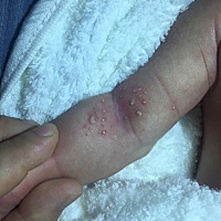 到处封了，医院也去不了，有知道这是什么的宝妈吗，我怕是疮一类的东西