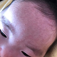 这是湿疹还是痤疮 宝妈们有没有好的方法 拜托拜托🙏