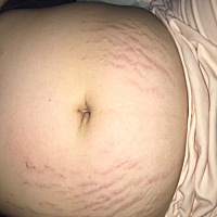 产后宝宝一周多了肚子上的妊辰纹还是特别明显，感觉好恐怖