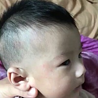 有什么好的治疗湿疹的奶粉推剪一下给我呀。