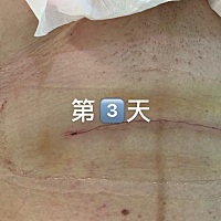 今天是2⃣️两个月8⃣️天。疤痕怎么就有点增生了，唉，那么好看的刀口。还是没躲过增生，大家帮忙看看...
