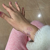 有无宝妈像我这样同款的，抱娃抱到手皮内出血的，如何办？
