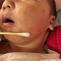宝妈们 这是什么情况呢？孩子一哭立马就起来了，睡一觉又好了，是湿疹吗？