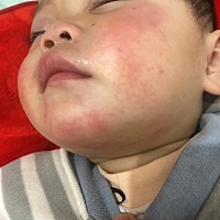 这是怎么了？需要涂什么？现在特殊情况又不想去医院。一岁多。