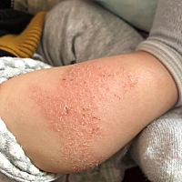 宝宝身上总是反复长这个、擦药好了又有、有谁知道怎么办帮帮我吧