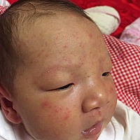 这是湿疹吗  最近没给捂热啊 要怎么弄才能尽快好呀 捉急 请求大家帮助