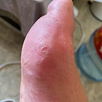 宝妈们 有没有生完孩子脚气特别严重的那种，特别痒 仔细看见还有密密麻麻的小点点 拿针扎烂就会流水，怎...