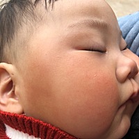 两边脸跟额头鼻子下巴颜色不一样 怎么办啊 好像是湿疹然后我擦了湿疹膏就变成图片这样发黄 红的这种 唉...