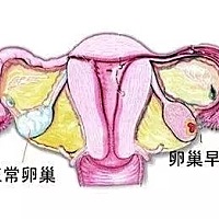 促排卵 …… 会造成卵巢早衰么？ 很多人想做试管的客人都有这样一个担忧：试管婴儿周期中因为促排卵的过...