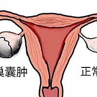 卵巢囊肿的由来，分为两种情况：一种是生理性的卵巢囊肿；另一种病理性的卵巢囊肿。生理性的卵巢囊肿是...