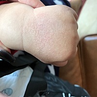 如图，宝宝6个月 但是手脚都这样，像一层透明痂裹着 摸着粗糙。 是什么回事，搽了润肤什么都不掉 没有红...