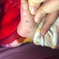 有宝妈知道这是什么吗，一点点水泡一样，里面有水，手和脚都有，好了又长出来