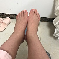 我的脚肿起来了 手也肿了 准备生了