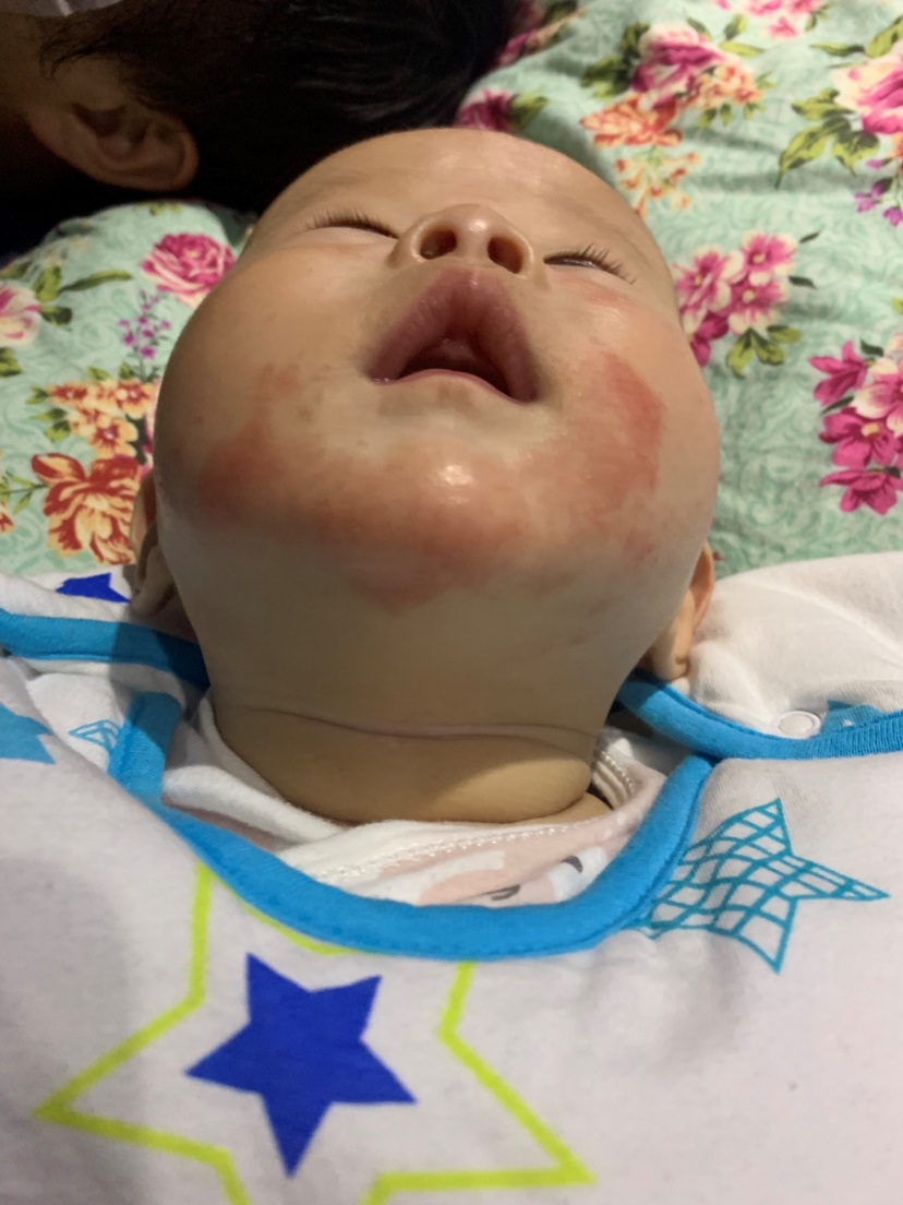 新手妈妈牢记这几点！（让宝宝少受罪）
1.勤换口水巾（有点湿就马上换，多备一点）
2.保持脸部滋润（涂抹润肤油）
3.奶水马上擦干
4.也是最有效的办法，看我宝宝太难受了，然后就听朋友推荐，用了戒之馆的婴亲霜，没想到两天就好多了😌（说一下我的用量，因为是涂在嘴巴周围很容易被他吃进去，虽然客服说吃一点没事，我还是害怕，就只涂了薄薄一层，早晚各涂一次）