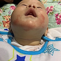 我儿子前段时间长了口水疹，半个月都没好（五个月的他正处于“口欲期”爱吃手，也在冒牙，所以口水分泌...