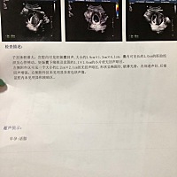 有没有跟我一样的情况～5 3了，积血2.2×2.1、心情很不美丽～现在吃的保胎药，让一个礼拜再去复查～希望...